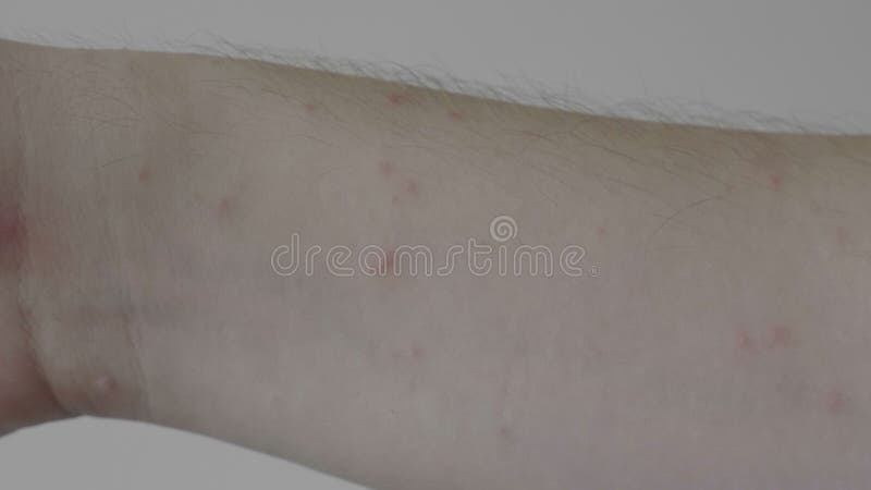 Piel estridente sensible del adolescente que muestra su brazo con síntomas impetuosos del eczema o de la alergia de la rojez - almacen de metraje de vídeo