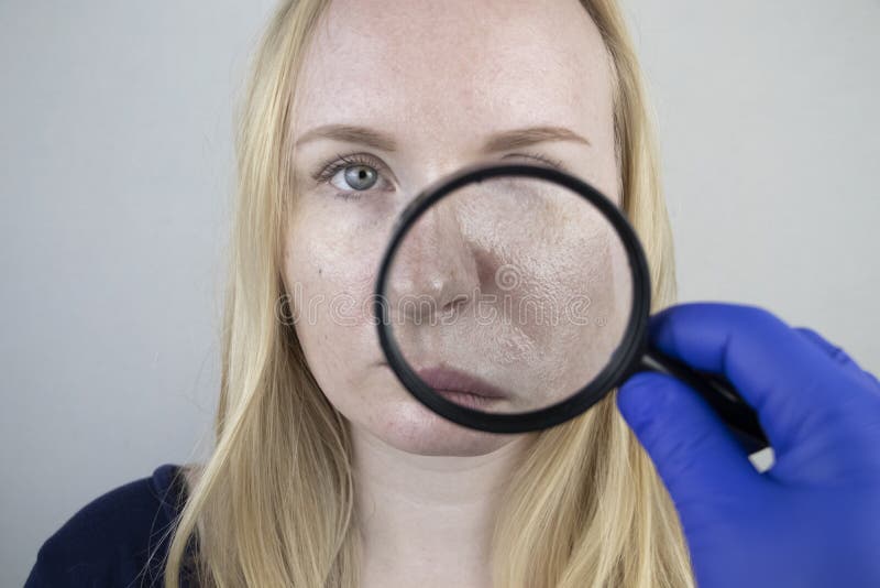 Piel Oleosa Y Problemática. Retrato De Una Chica Rubia Con Piel