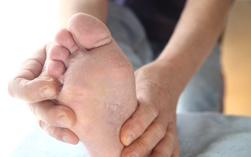 A man checks the dry, peeling skin of his athletes foot fungus between his toes. A man checks the dry, peeling skin of his athletes foot fungus between his toes.