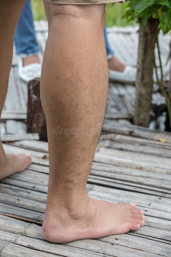 Melenudas Con Las Manchas Y Lunares En La Piel Foto de archivo - Imagen piernas, hombre: 121613430