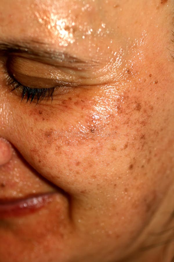 Pigmented Spots On The Face. Pigmentation On Cheeks Stock Image - Image