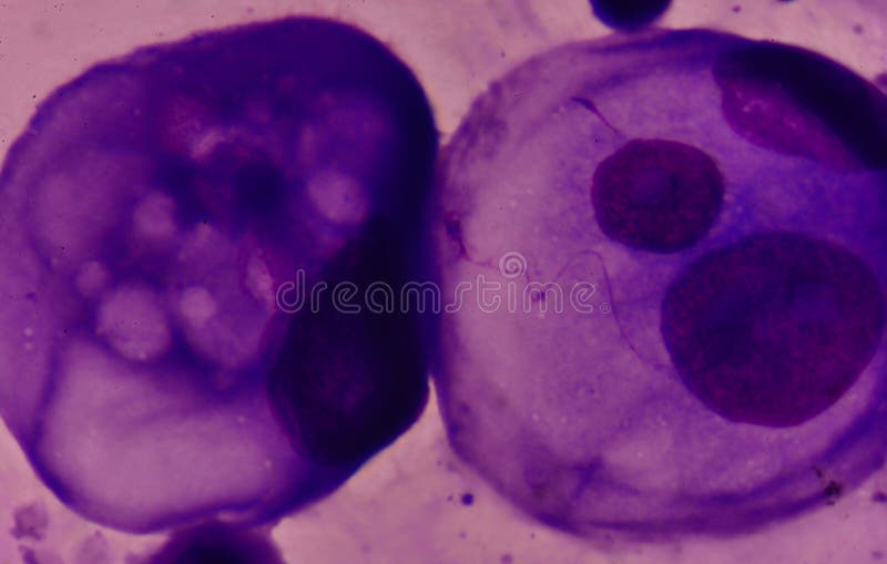 Malignant cells in pleural fluid analysis with microscope. Malignant cells in pleural fluid analysis with microscope.