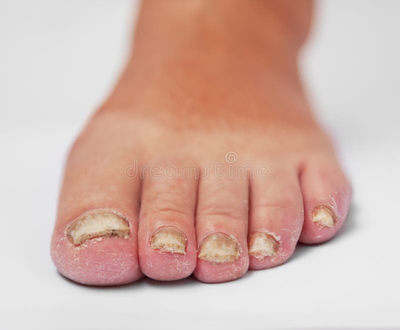 Fungoid disease of a nail. Fungoid disease of a nail