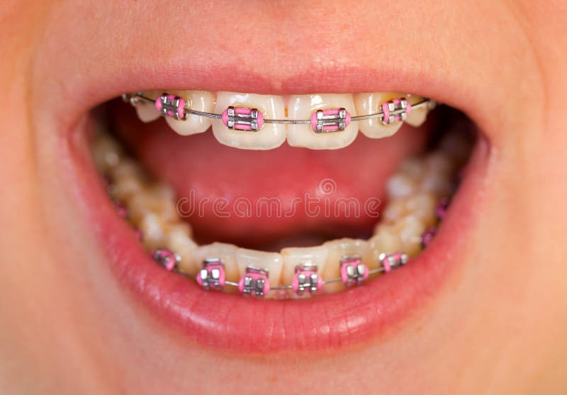 Pink braces stock image. Image of brace, grin, floss, orthodonture