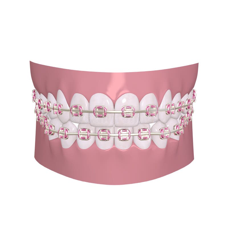 Braces Corrective Orthodontics Stock Vector Illustration of hygiene, medicine 22280433