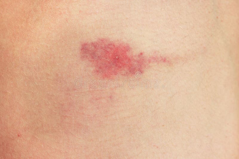 Piqure De Moustiques De Moucheron Reaction A La Piqure De Moucherons Allergie Danger Des Piqures D Insectes En Ete Tache Rouge Su Image Stock Image Du Moucherons Sante Piqure De Moustiques De Moucheron Reaction A La Piqure De Moucherons Allergie Danger Des Piqures D Insectes En Ete Tache Rouge Su Image Stock Image Du Moucherons Sante