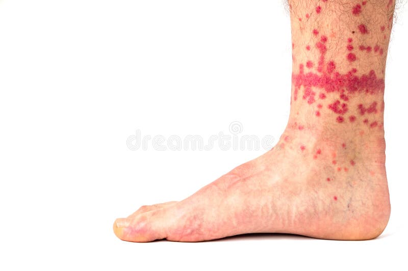 Piqûres de puce sur la jambe humaine image stock Piqûres de puce sur la jambe humaine image stock