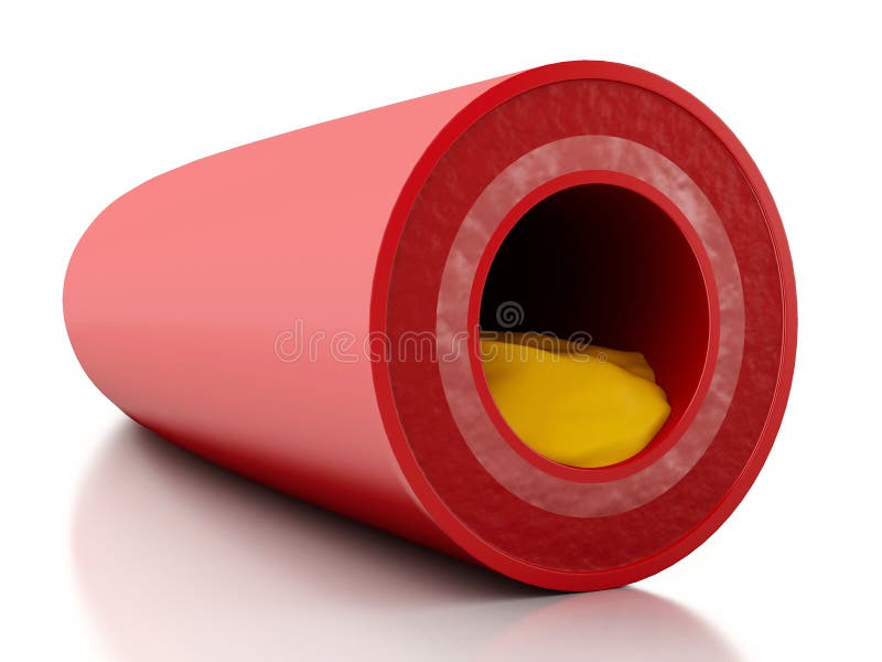 placca del colesterolo 3d in arteria royalty illustrazione gratis placca del colesterolo 3d in arteria royalty illustrazione gratis