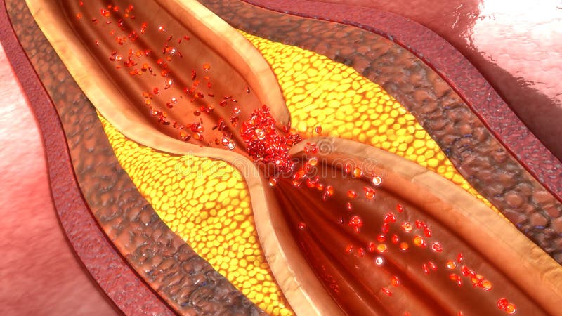 Placca dell'arteria coronaria immagine stock Placca dell'arteria coronaria immagine stock