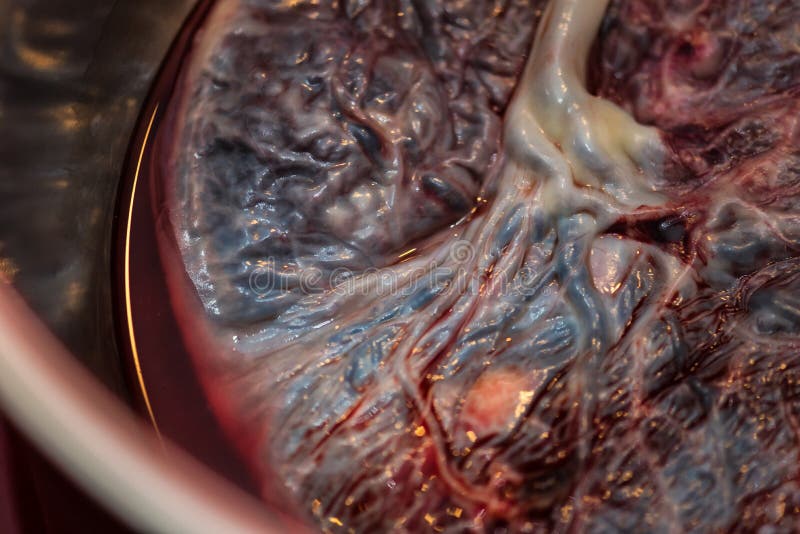 Placenta birthed at home