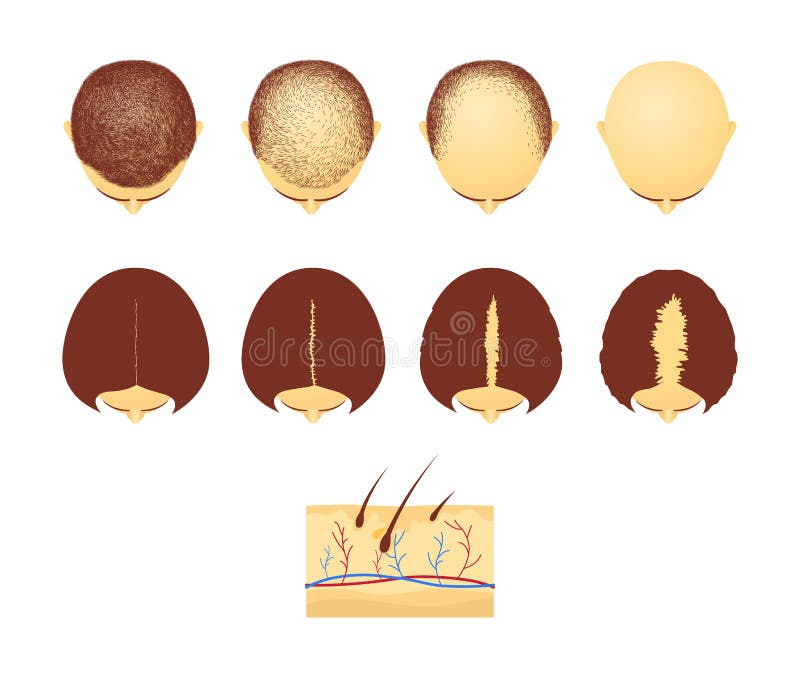 Placez des têtes masculines et femelles dans la vue supérieure avec le style de bande dessinée de perte des cheveux illustration stock Placez des têtes masculines et femelles dans la vue supérieure avec le style de bande dessinée de perte des cheveux illustration stock