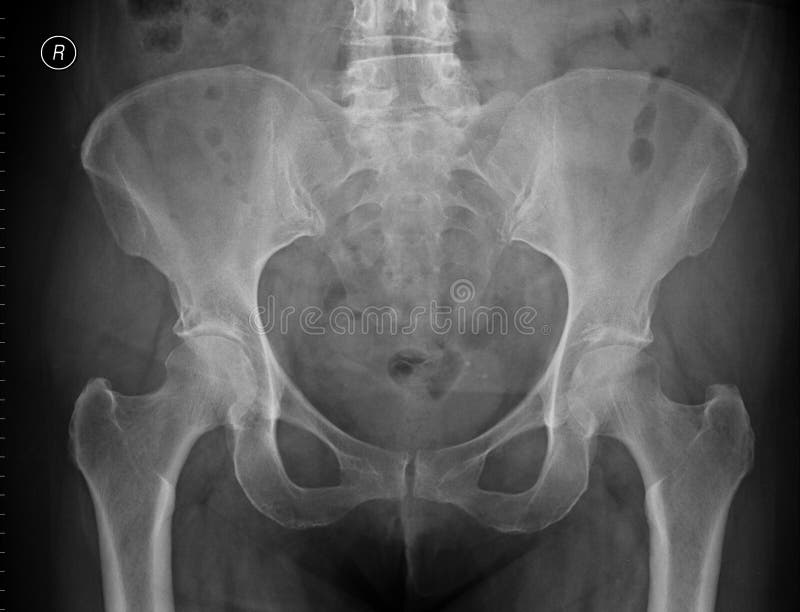 Pelvis Xray Anatomy Pelvis Xray Anatomy