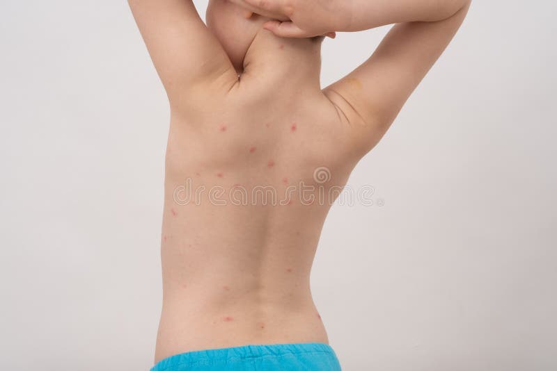 Plan rapproch? de dos de gar?on avec le virus ou la varicelle de Varicella ?ruption de bulle sur l'enfant images libres de droits Plan rapproch? de dos de gar?on avec le virus ou la varicelle de Varicella ?ruption de bulle sur l'enfant images libres de droits