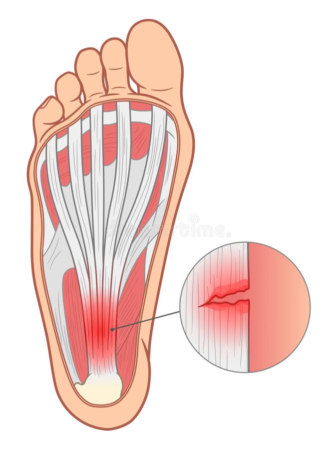 Plantar Fasciitis Vector Illustration. Labeled Human Feet Disorder