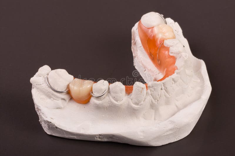 Plaster Cast of Teeth with Removable Partial Denture on a Dark