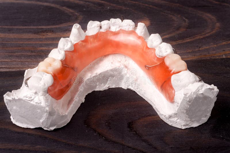 Plaster Cast of Teeth with Removable Partial Denture on a Dark Wooden