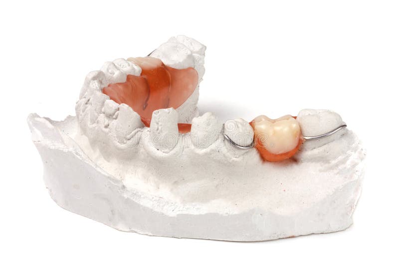 Plaster Cast of Teeth with Removable Partial Denture Isolated on White