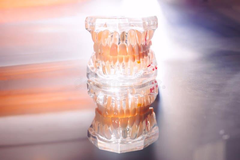 Plastic Mold of a Jaw with Teeth, on a Dentist`s Stainless Table Stock