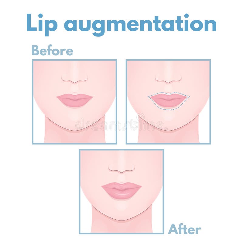 Plastic surgery lip stock vector. Illustration of cosmetic 62347329