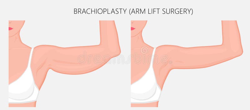 Plastikowy surgery_Brachioplasty lub ręka dźwignięcie