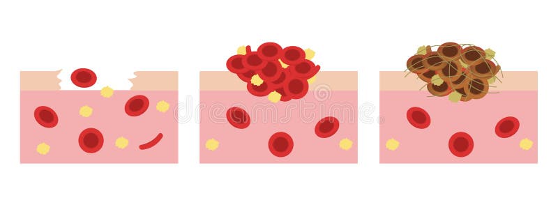 Platelet and fibrin on wound