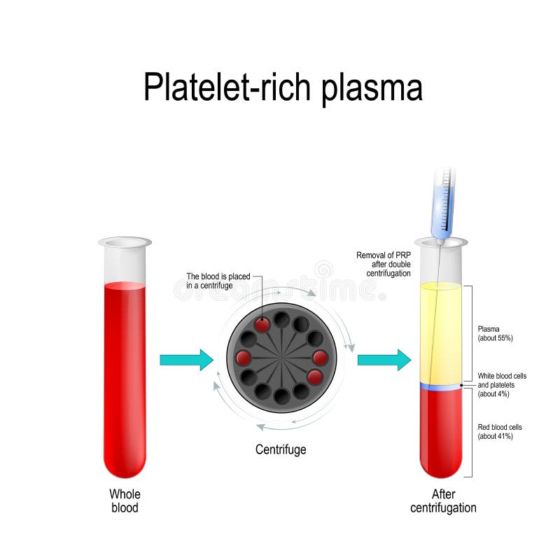 Platelet-rich plasma stock vector. Illustration of centrifuge - 137533295