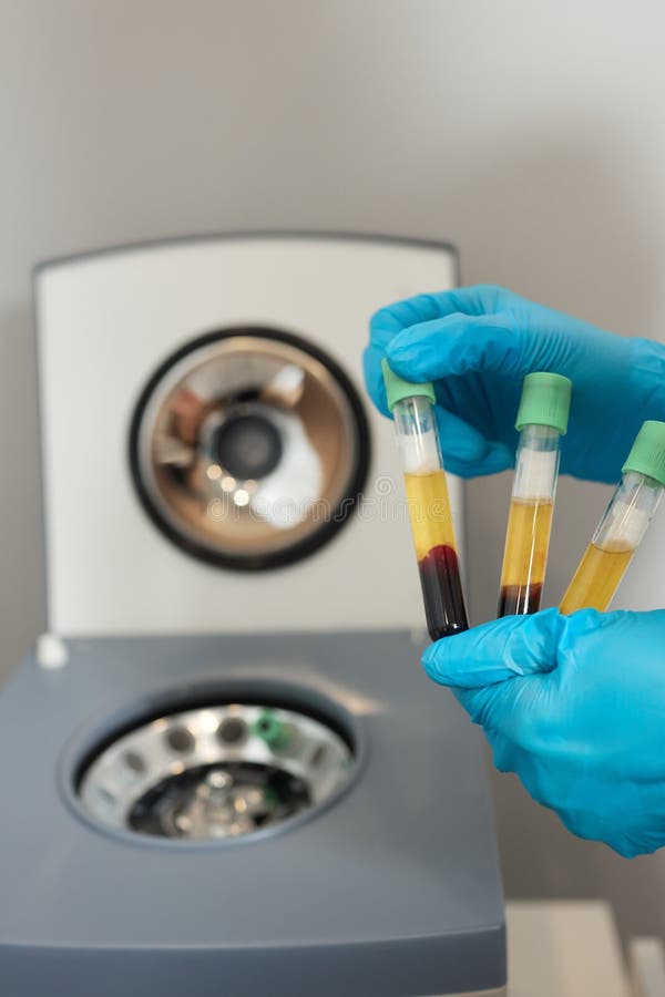 PlateletRich Plasma Preparation. Plasma in Syringe. Centrifuge. Stock Image Image of