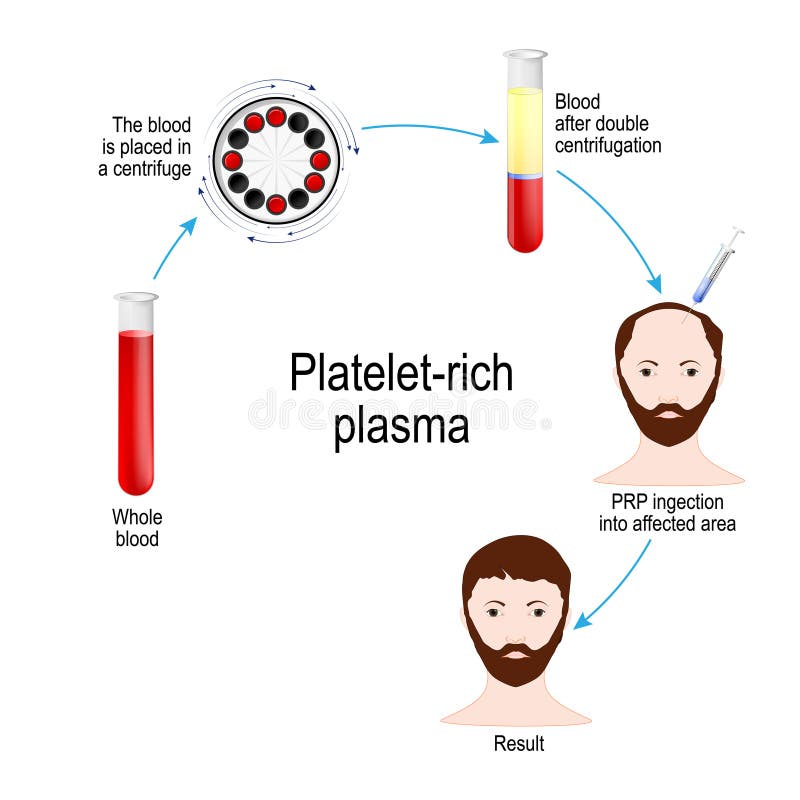 Platelet-rich plasma. PRP Hair Therapy. Medical procedure vector illustration Platelet-rich plasma. PRP Hair Therapy. Medical procedure vector illustration