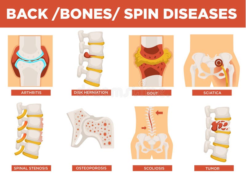 Back, bones and human spin diseases explanation vector. Disk herniation and gout, sciatica and spinal stenosis, osteoporosis illness set. Scoliosis crooked backbone, tumor in body of patient. Back, bones and human spin diseases explanation vector. Disk herniation and gout, sciatica and spinal stenosis, osteoporosis illness set. Scoliosis crooked backbone, tumor in body of patient