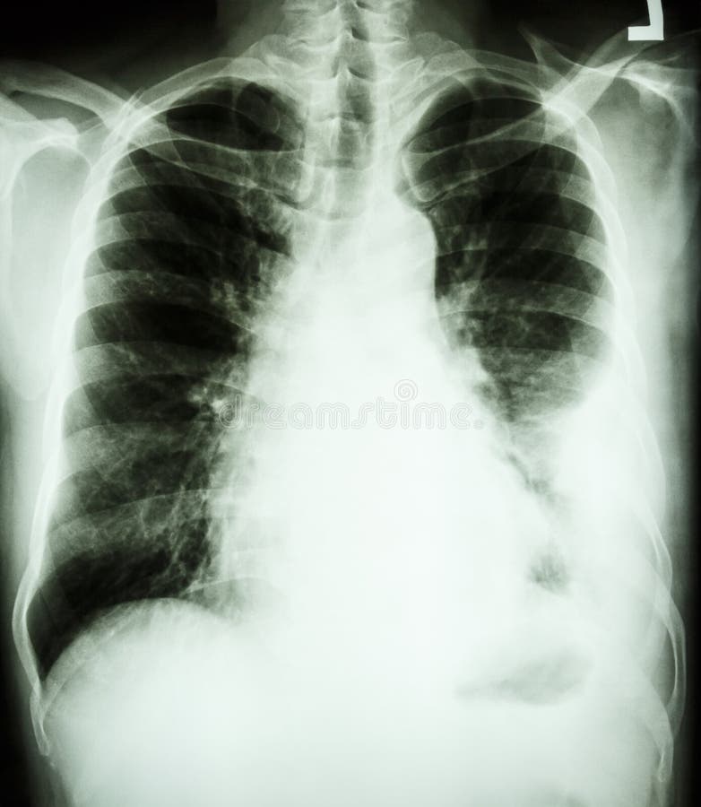 Pleural effusion at left lung due to lung cancer