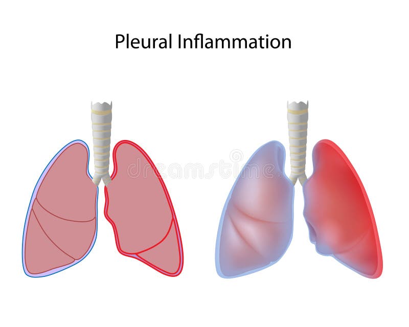 Inflammation of pleura of the lungs, eps10. Inflammation of pleura of the lungs, eps10