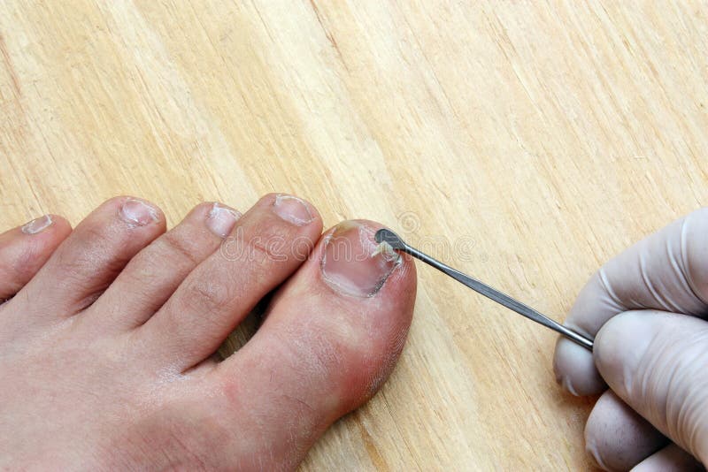 Plucking nail stock image. Image of foot, broken, agnail - 38111551