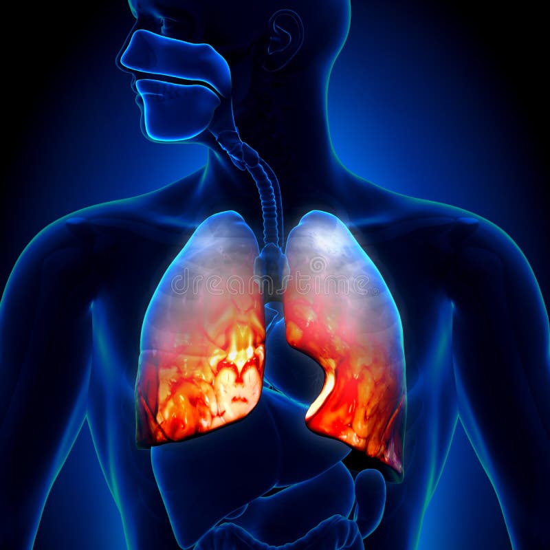 Pneumonia - Lungs Inflammatory Condition - detailed view. Pneumonia - Lungs Inflammatory Condition - detailed view