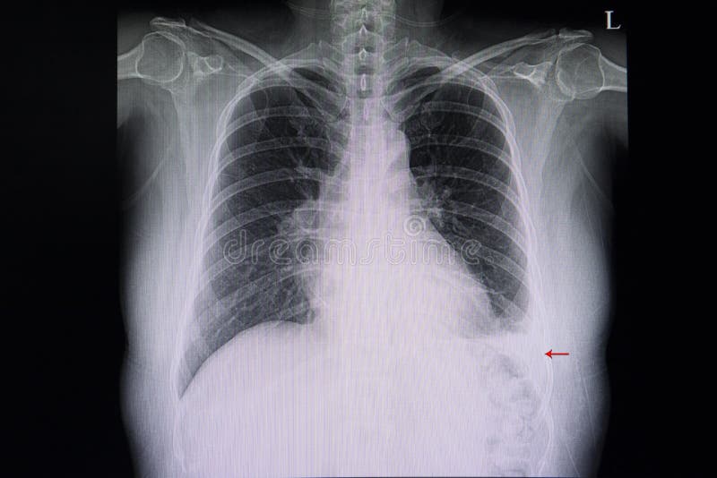 Pneumonie Image Stock Image Du Pulmonaire Docteur