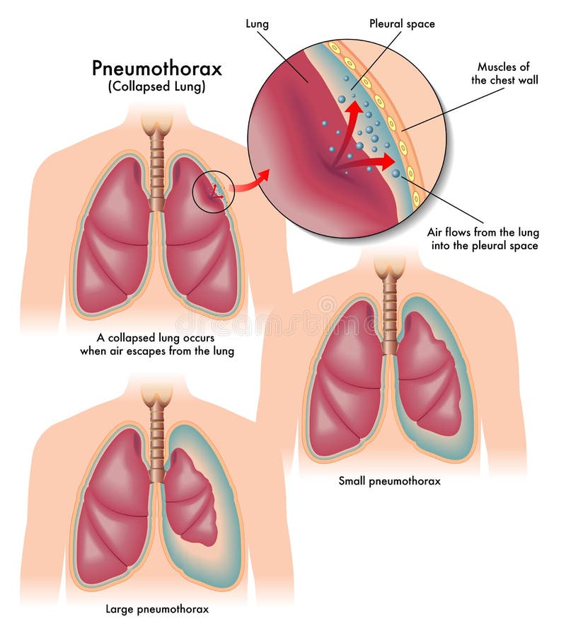 Illustrazione medica dei sintomi di pneumotorace.
