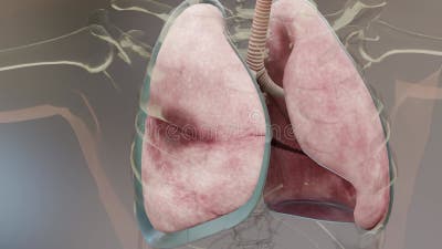 Pneumothorax poumon normal versus symptômes effondrés de pneumothorax