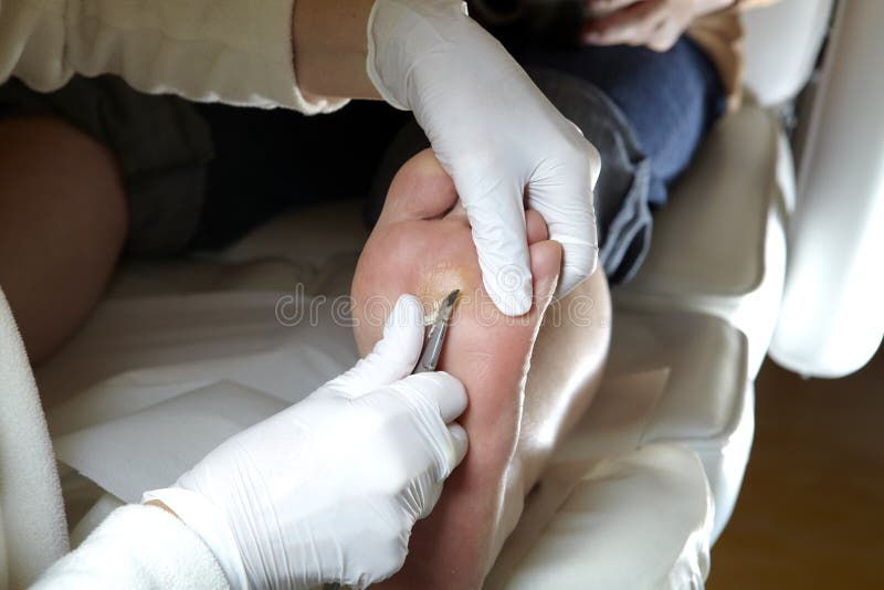 Medicinal Pedicure. The Doctor Removes The Imprint On The Foot With A  Scalpel Stock Photo, Picture and Royalty Free Image. Image 77227900.