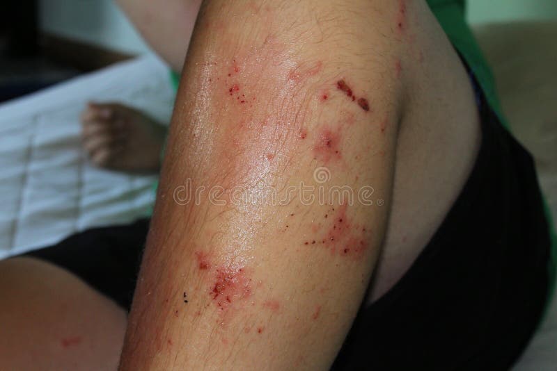 Poison Ivy Rash stock image. Image of dangerous, healthcare 73348247