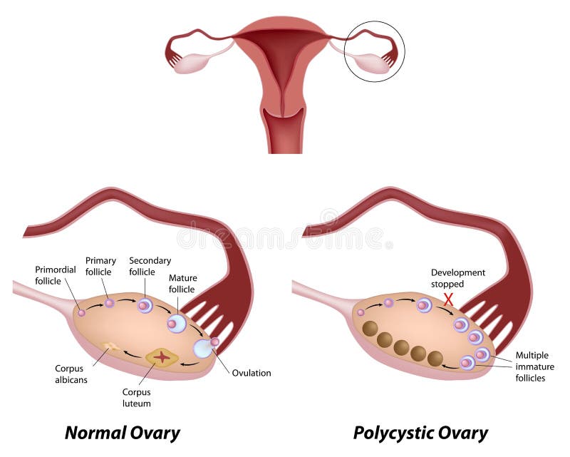 Polycystic ovary syndrome royalty free illustration