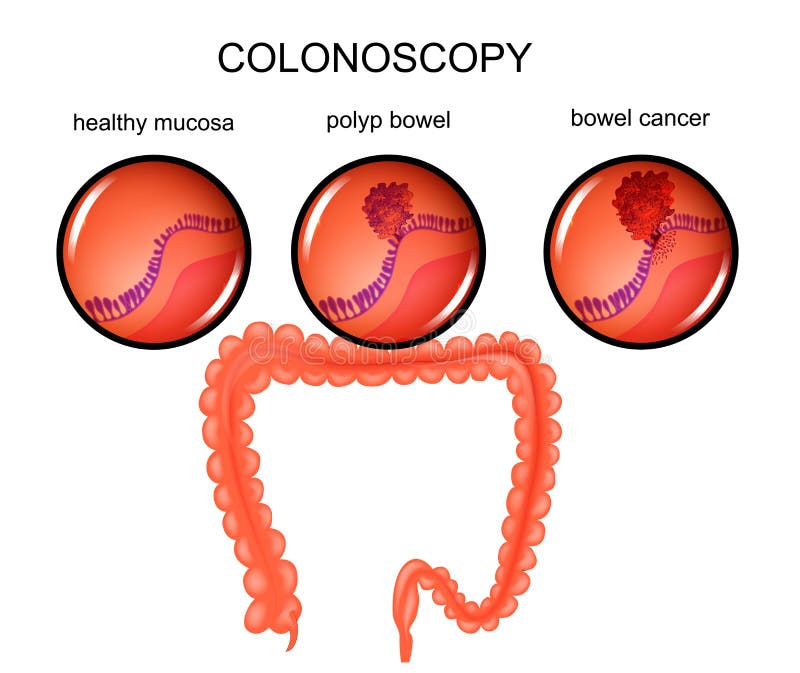 Vector illustration of a colon polyp and cancer. Vector illustration of a colon polyp and cancer