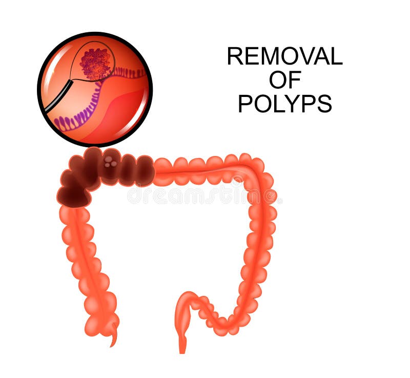 Vector illustration of polyps in the colon. removal of polyps