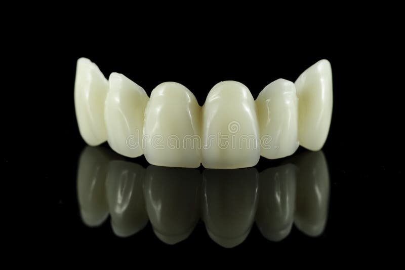 Ponticello dentale del dente fotografia stock Ponticello dentale del dente fotografia stock