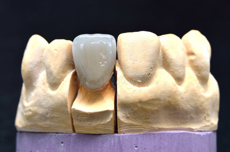 Porcelain Teeth Dental Implant Stock Photo Image of technology, crown