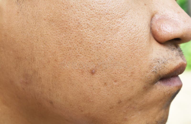 Pores and oily on surface young asian man face skin do not take care for a long time royalty free stock photo Pores and oily on surface young asian man face skin do not take care for a long time royalty free stock photo