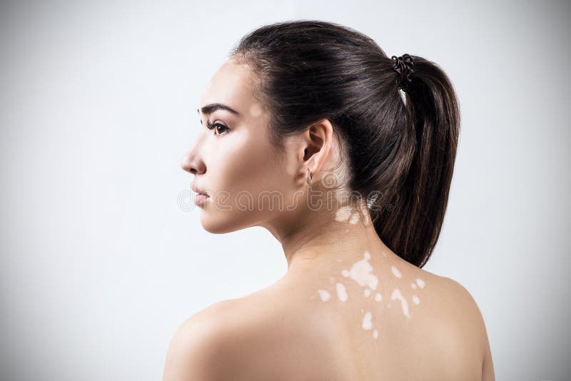 Portrait of beautiful woman with vitiligo.