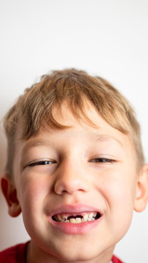 Portrait of a Boy with Bad Teeth, Fallen Front Upper Teeth Stock Image