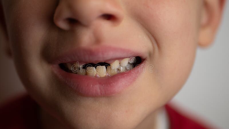Portrait of a Boy with Bad Teeth, Fallen Front Upper Teeth Stock Image