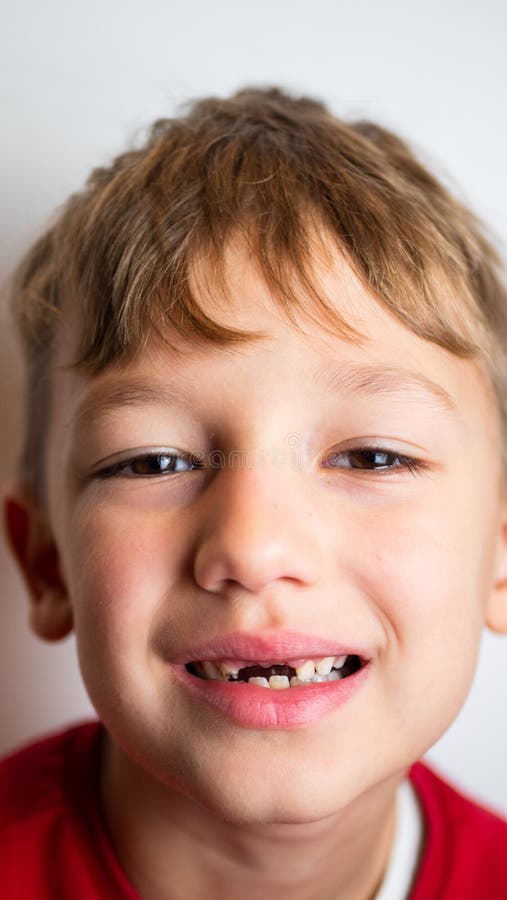 Portrait of a Boy with Bad Teeth, Fallen Front Upper Teeth Stock Image