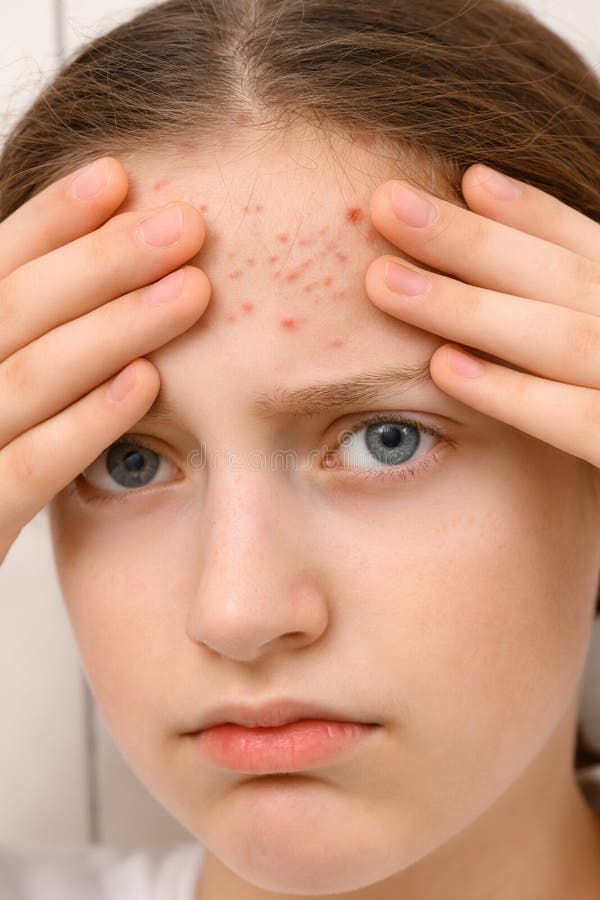 Portrait Of A Teenage Girl Touches Her Face With Pimples Acne On The