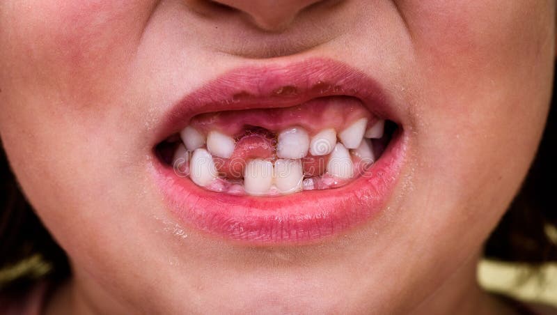 Portrait of toothless child girl missing milk and permanent teeth.